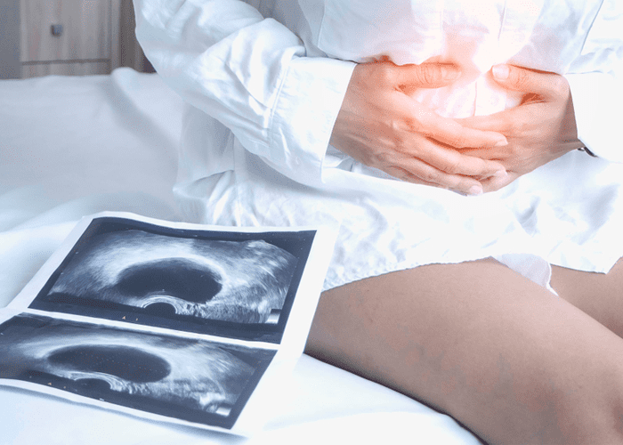 Ovarian Cyst Removal in Calicut