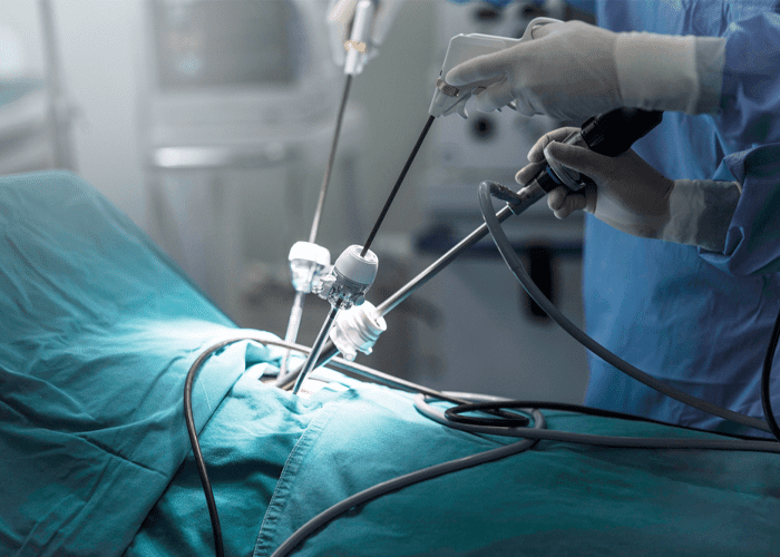 Laparoscopic Uterine Suspension in Calicut